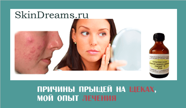 Прыщи на щеках у женщин: причина и лечение