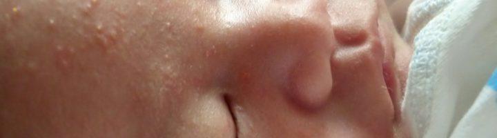 Как выглядит аллергия на коже у ребенка, фото, виды, лечение