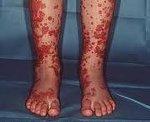 Геморрагическая сыпь - фото у детей, на ногах, на лице, на ягодицах, причины, васкулит