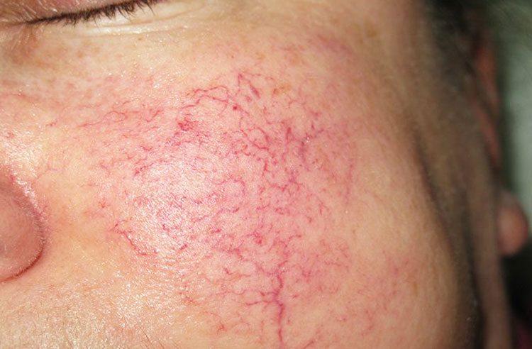 Купероз кожи лица лечение