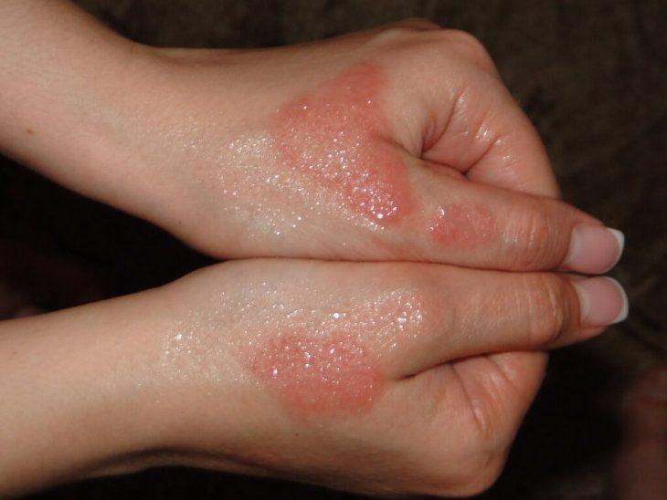 Эффективная мазь от дерматита на руках для взрослых и детей