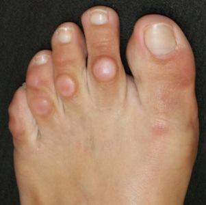 Сухие мозоли на пальцах ног: причины, лечение, профилактика