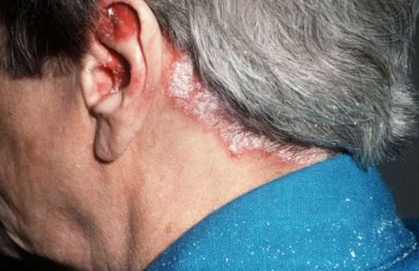 Чем лечить кожу головы при псориазе